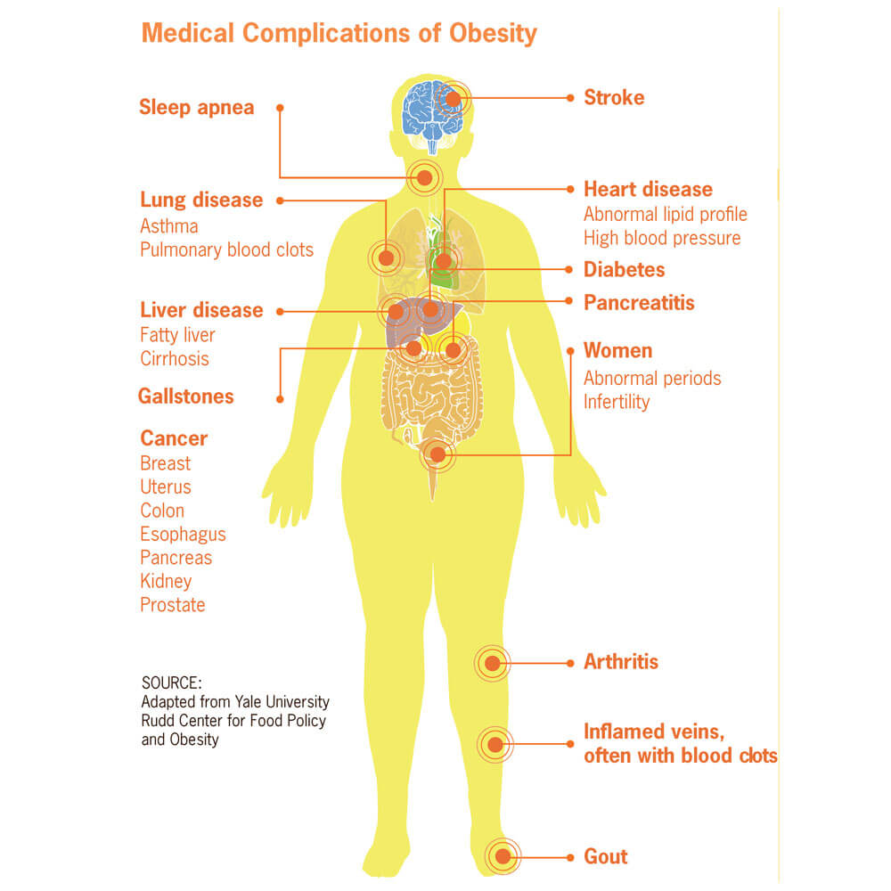 Complication of Obesity, obesity medication near me